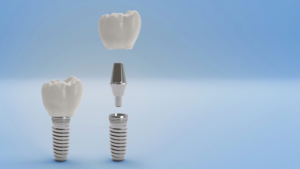 Dental Implants in Nederland, TX